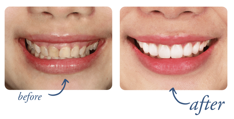 IMG-smile-makeover-02-min (1)